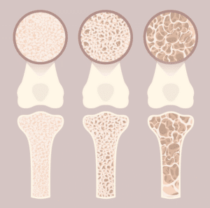 Zunehmende Schwächung der Knochensubstanz im Verlauf einer Osteoporose